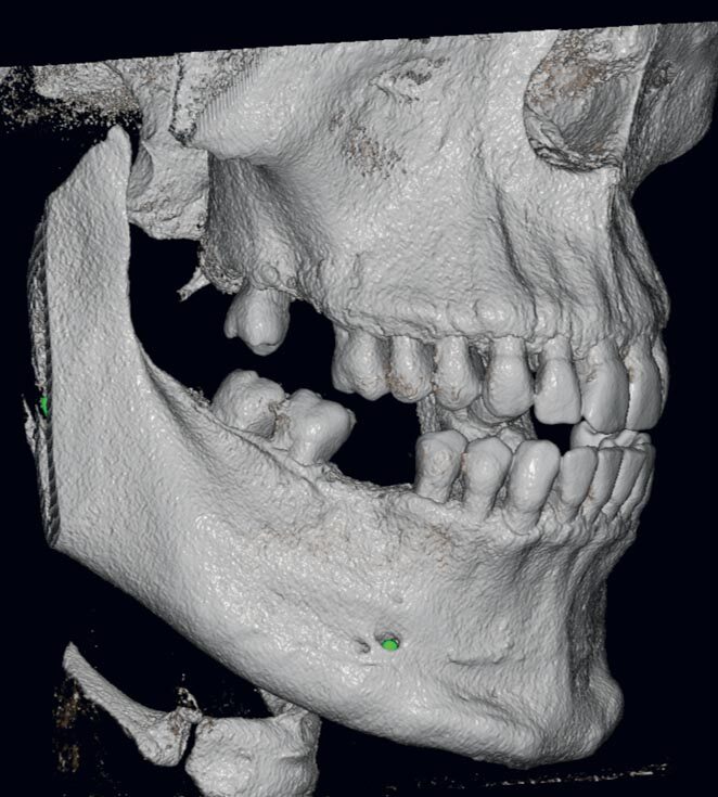 Reconstrucción 3D de un volumen CBCT del NewTom VG-One