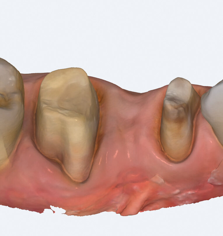 Modelo 3D de una arcada obtenido con el NewTom ViSIOScan