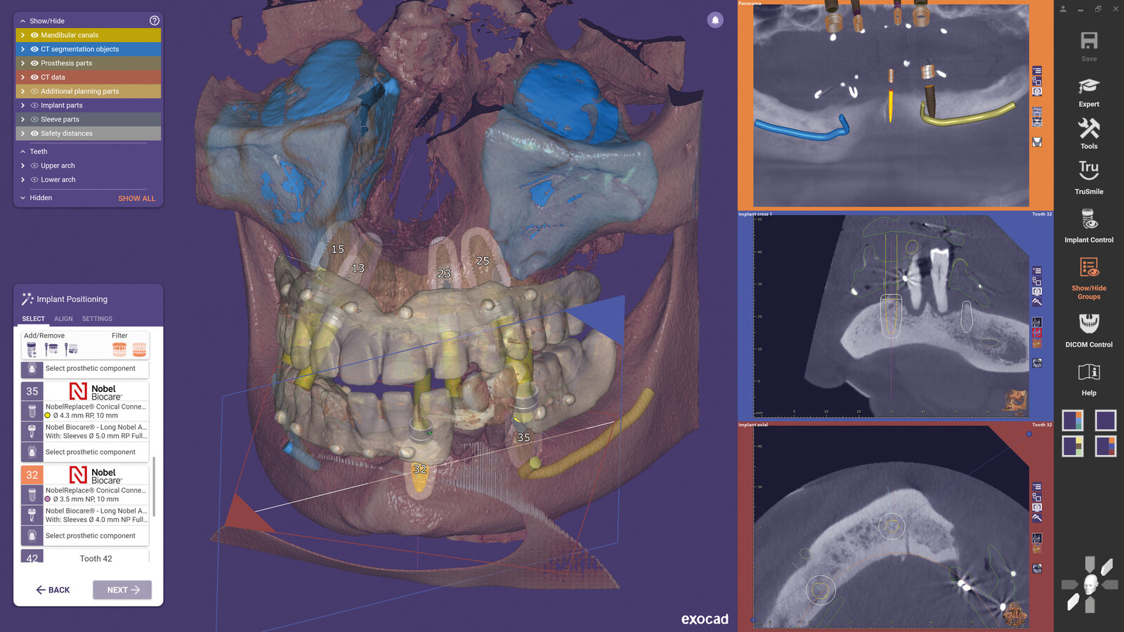 Planificación implantológica en exocad exoplan a partir del escaneado ViSIOScan