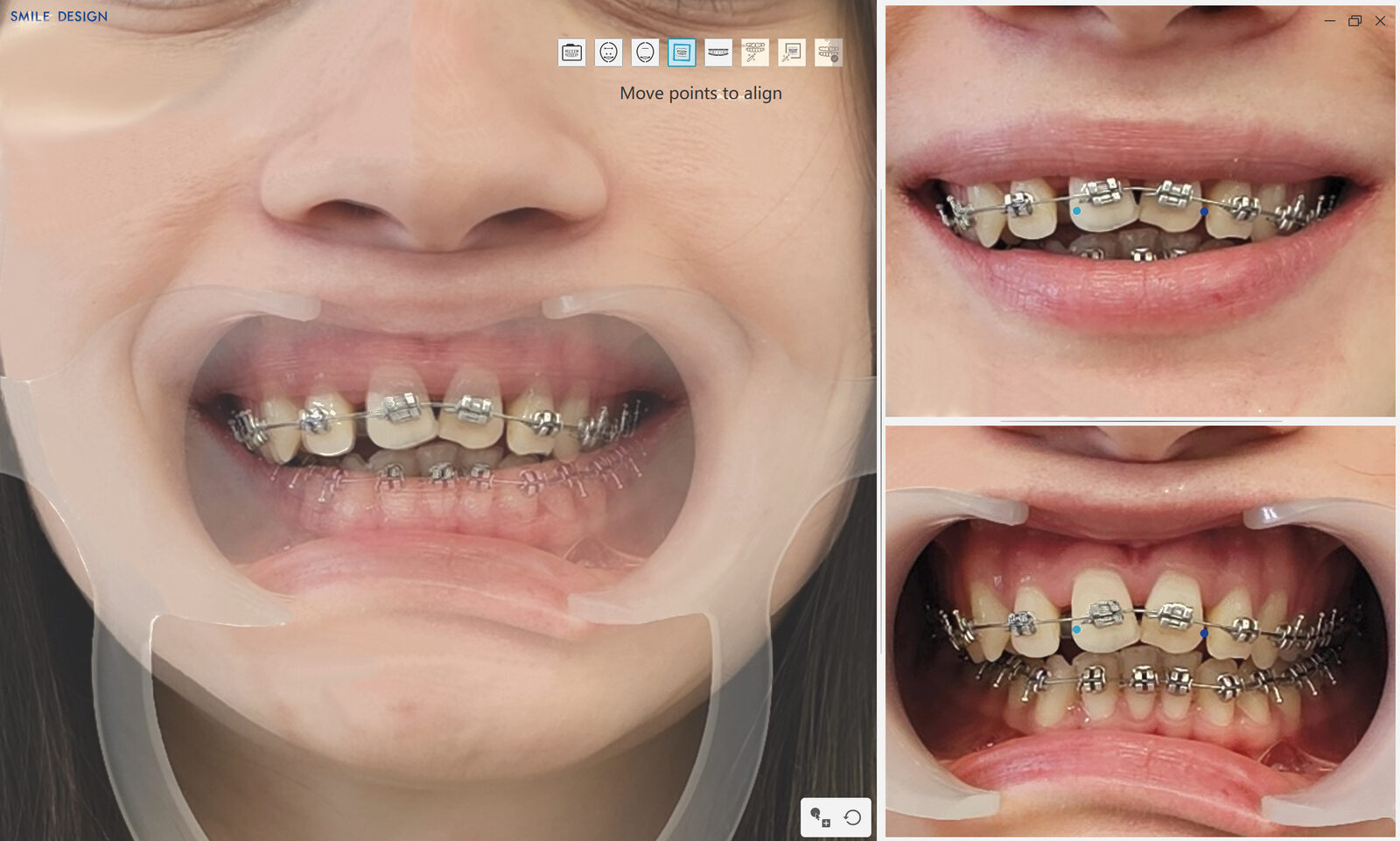 Smile Design: diseño de sonrisa sobre el escaneado del ViSIOScan