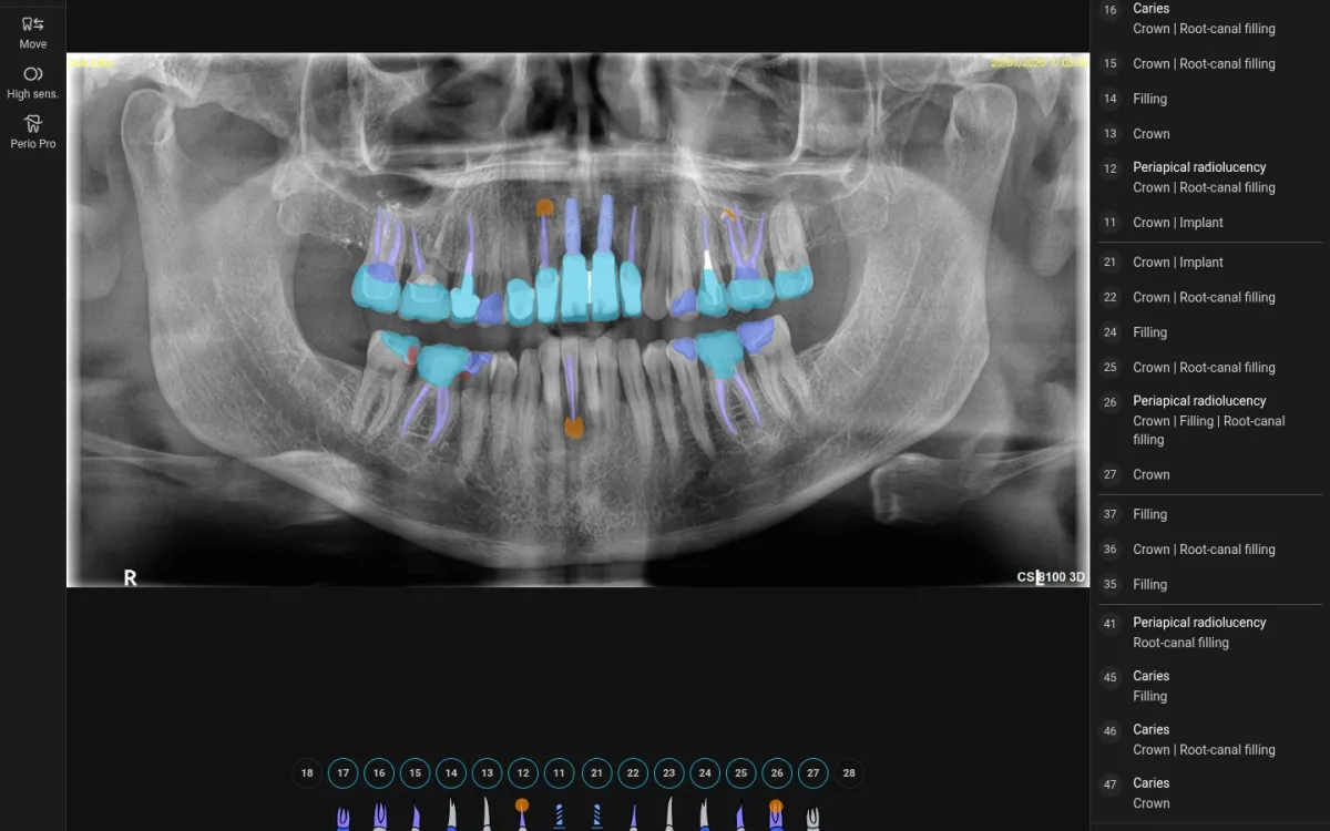 AI Insights analizando una radiografía panorámica con coronas, implantes y endodoncias marcadas por colores