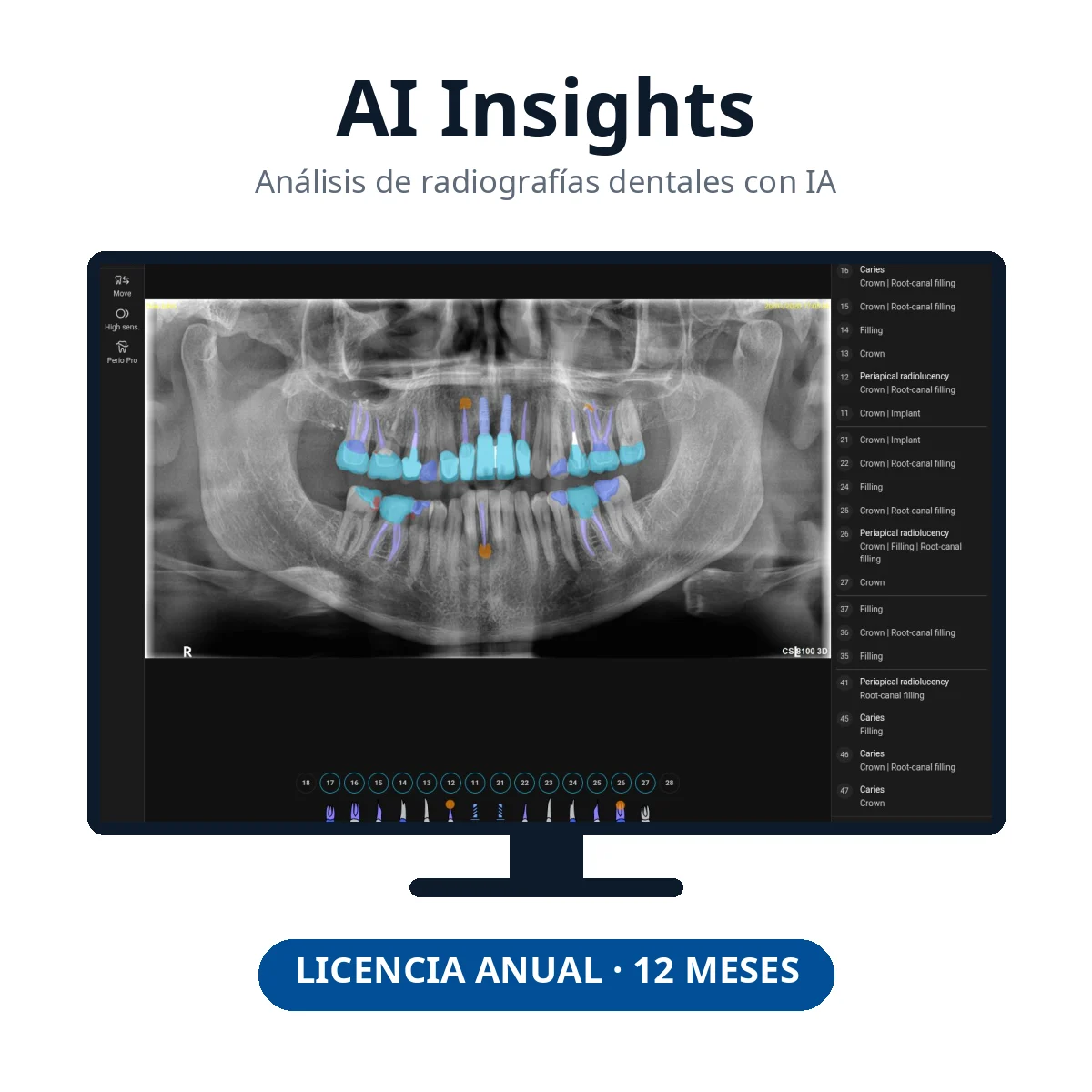 AI Insights de Carestream Dental: licencia anual de inteligencia artificial para radiografías dentales