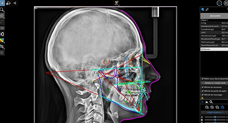 Telerradiografía con trazado automático