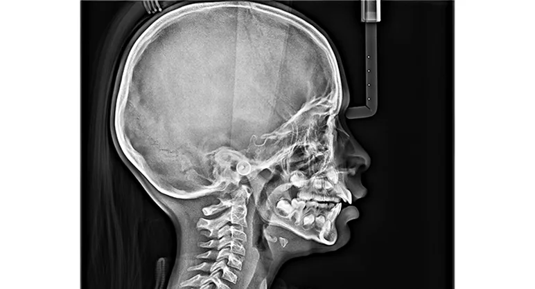 Telerradiografía lateral de cráneo