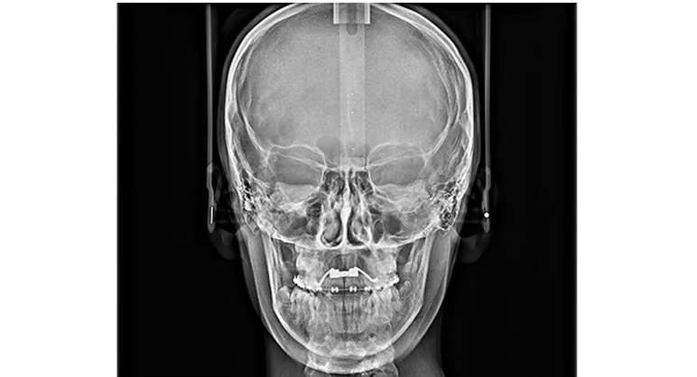 Telerradiografía frontal PA