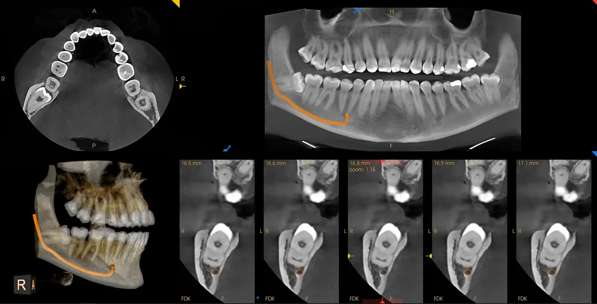 Cirugía oral: tercer molar incluido