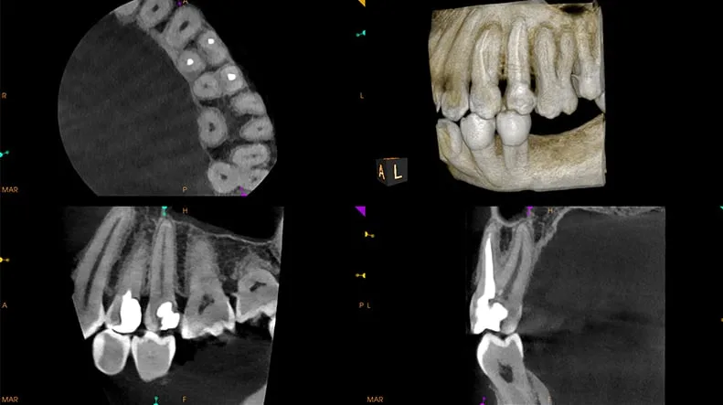 Endodoncia: conducto no obturado en 5×5 cm HR