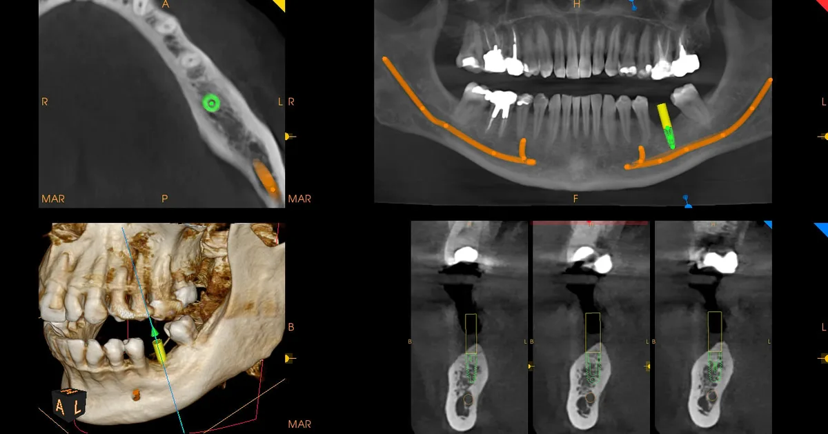 Planificación de implantes en 12×10 cm con CS MAR