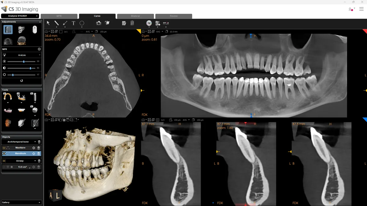 Periodontitis en 12×10 cm, vista MPR