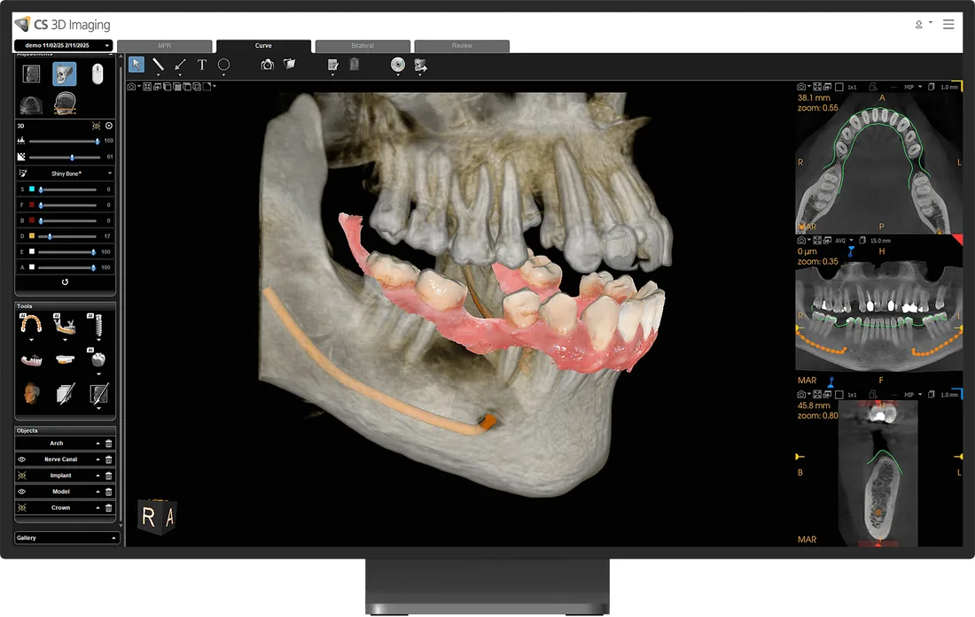 IA: fusión automática del CBCT con el escaneo intraoral