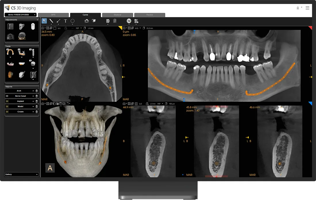 IA: trazado automático de curva panorámica y canal mandibular