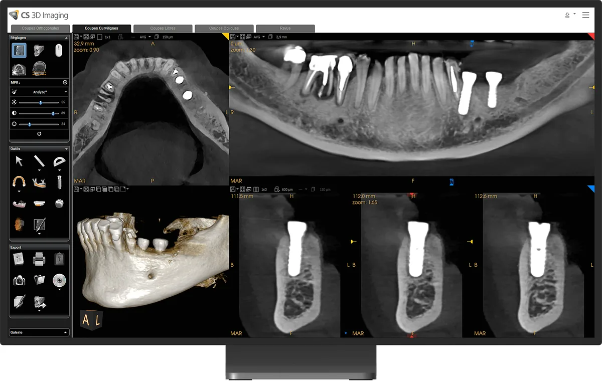 Control de implantes en 12×5 cm con reducción de artefactos metálicos CS MAR