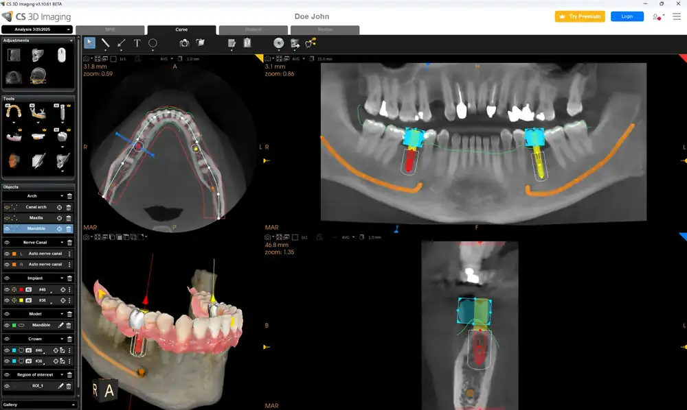 Planificación automática de dos implantes con corona virtual en CS 3D Imaging Premium