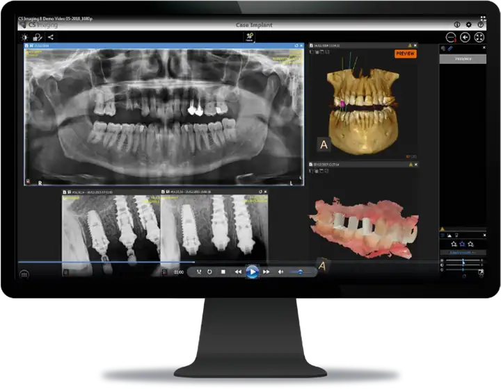 CS Imaging 8 mostrando panorámica, volumen 3D, implantes y modelo CAD/CAM en una misma pantalla